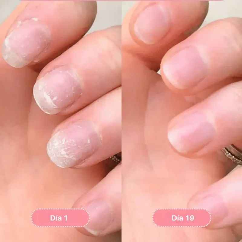 Nailix™: Lápiz para el crecimiento de uñas con células madre
