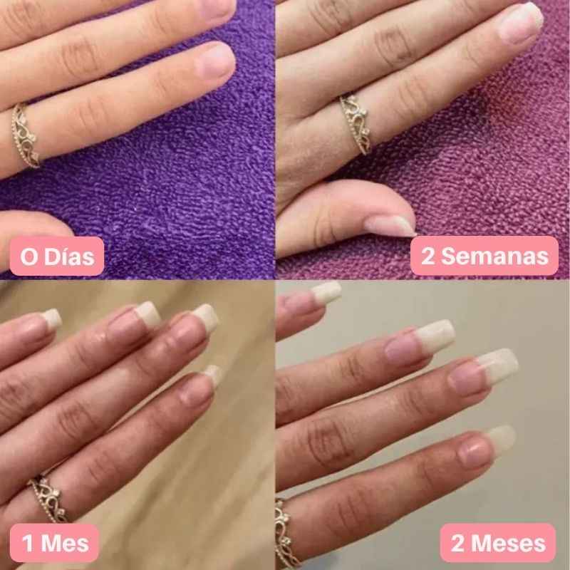 Nailix™: Lápiz para el crecimiento de uñas con células madre