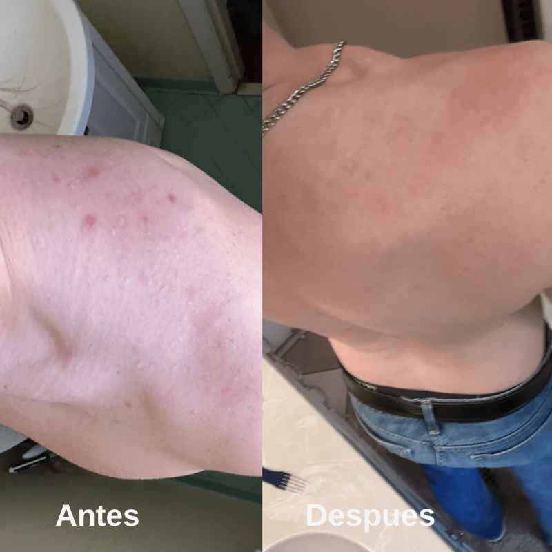 Shield™: Jabón Corporal para el Acné + Regalos