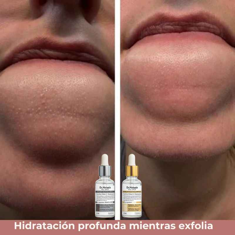 PeelShot™: Tratamiento Coreano exfoliante suave de Arroz negro