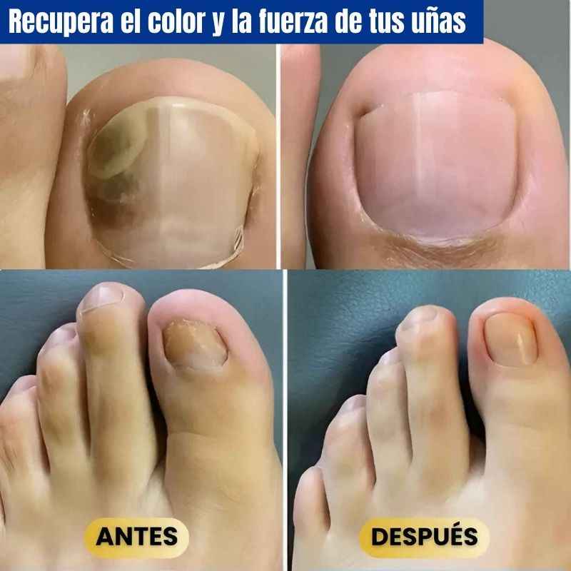 Tratamiento Profesional Anti-Hongos | Promo 2X1