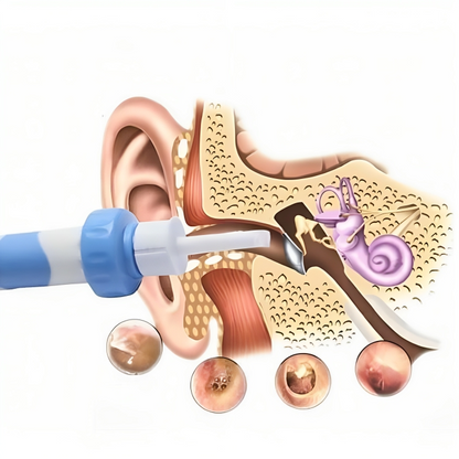 Aspirador de cera para oídos | CleanEar Pro👂