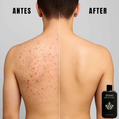 Shield™: Jabón Corporal para el Acné + Regalos