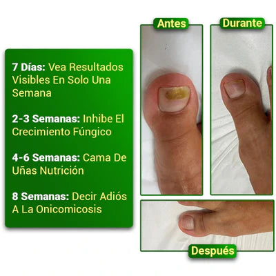 NailTreatment™: Tratamiento de hongos para las uñas | Paga 1 Lleva 2