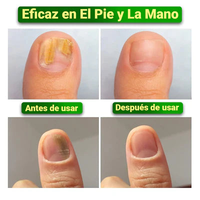 NailTreatment™: Tratamiento de hongos para las uñas | Paga 1 Lleva 2